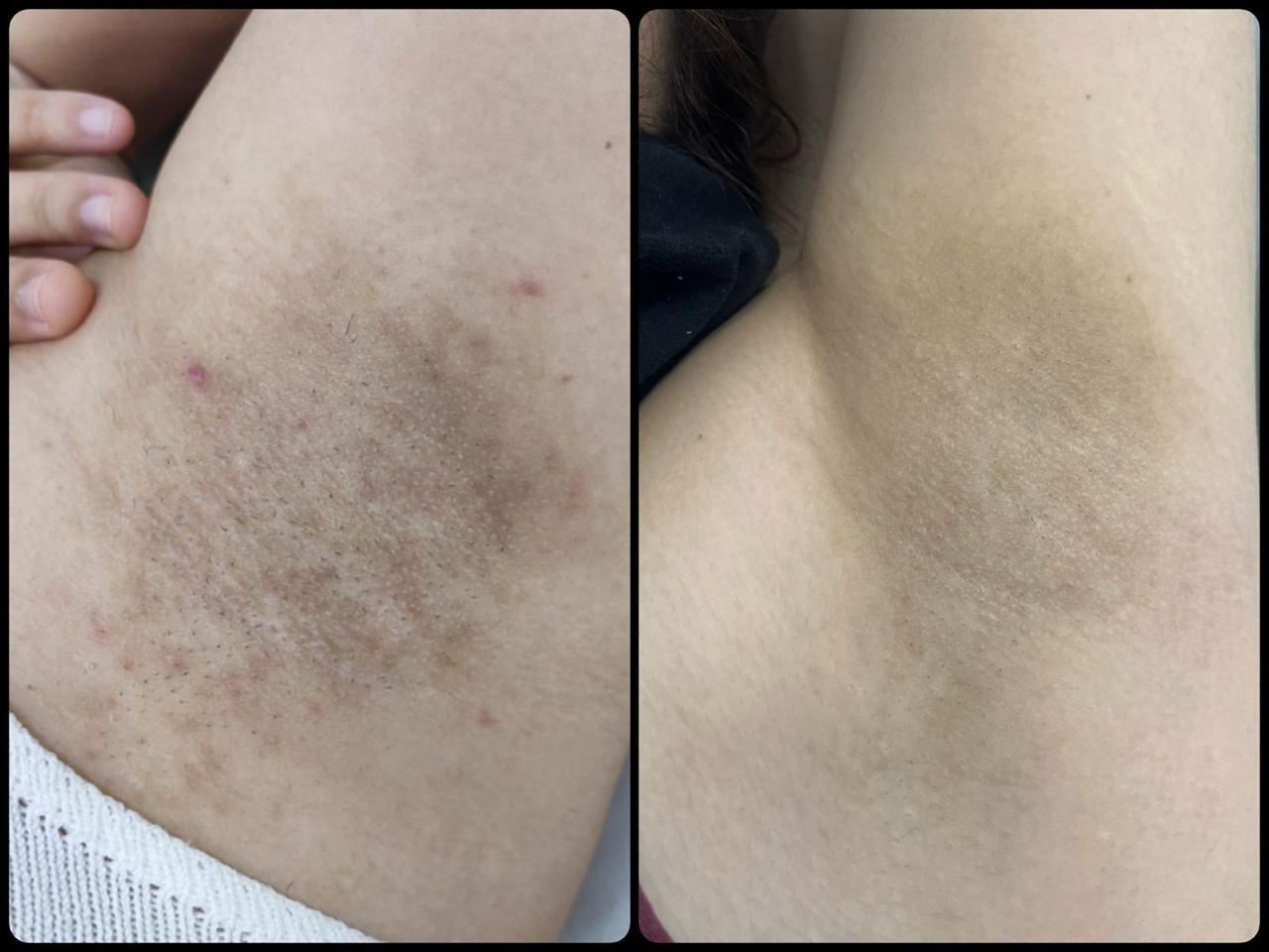 Axila antes e depois das sessões de laser