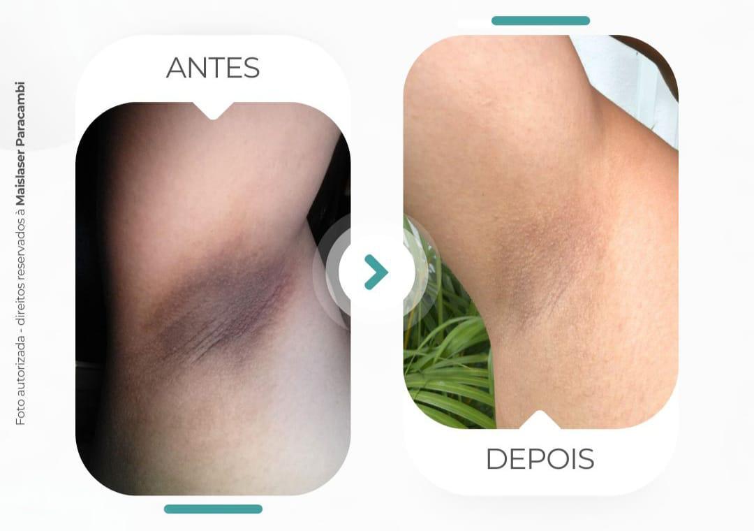 Axila antes e depois do tratamento