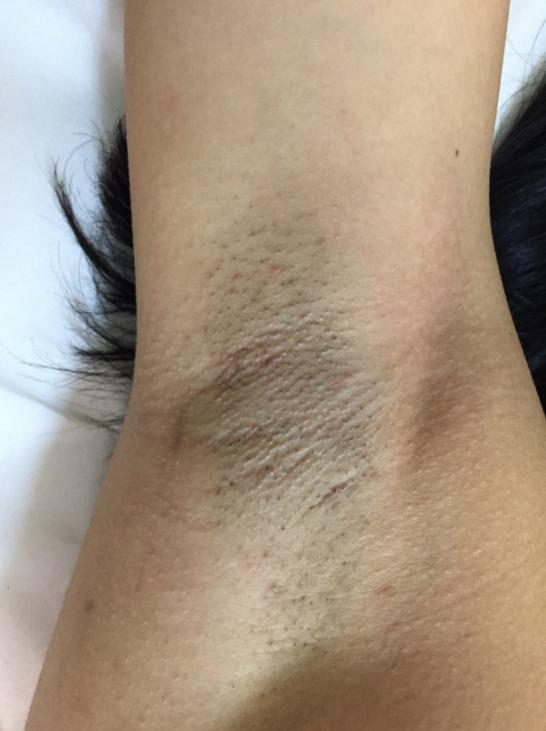 Axila antes do laser: pelos encravados e região escura